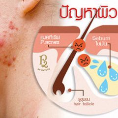 ปัญหาผิว สิวอักเสบของคนไทย