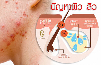 ปัญหาผิว สิวอักเสบของคนไทย